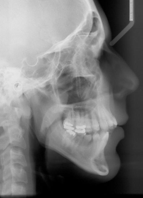 Outra opção de tratamento possível seria a correção apenas através da extrusão dos dentes anteriores utilizando-se dobras de extrusão e elásticos verticais anteriores.