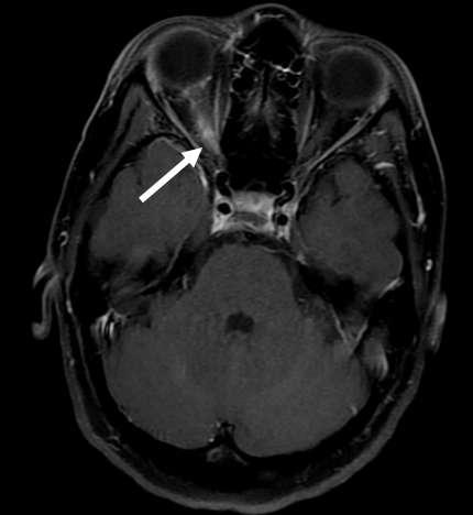 NMO e EM neurite