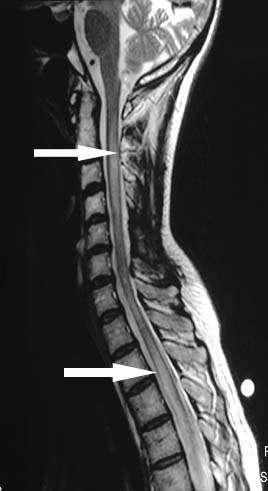 Introdução Neuromielite óptica Diferenças: