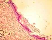 Melanócitos presentes na camada basal em forma de granulações.