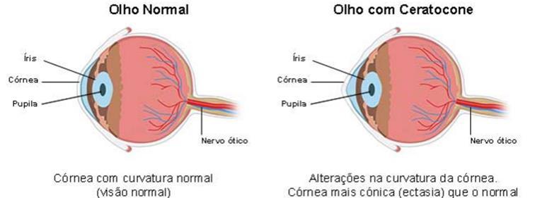TRATAMENTO DO CERATOCONE COM INTACS 2016 3.DISCUSSÃO O ceratocone é uma doença ocular, não infecciosa na qual a córnea enfraquece devido a anomalias estruturais e de composição.