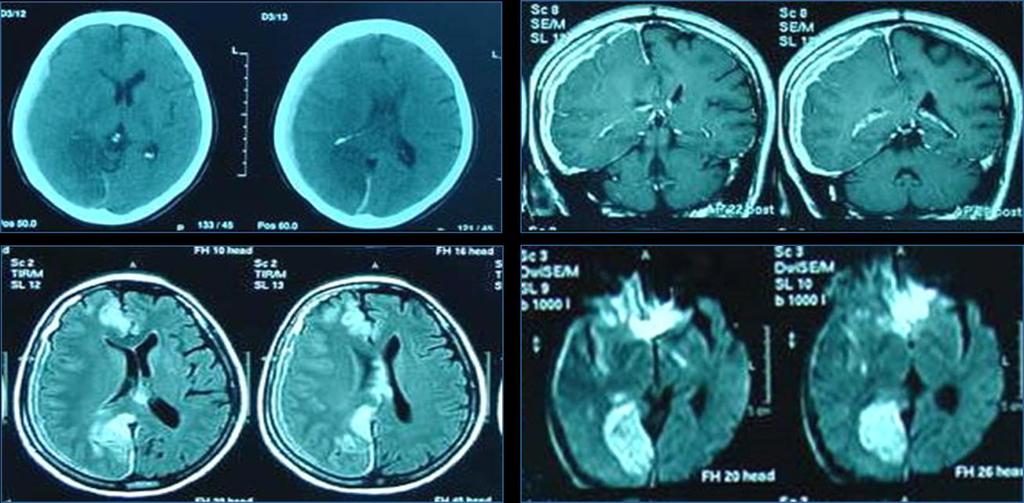 5. Inchaço cerebra difuso e hemisférico: -Etiologia: Hiperemia cerebral -vasodilatação- aumento volume intravascular Aumento de volume intracraniano-