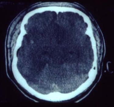 - Agudo ou ser tardio (horas ou mesmo dias) - Edema surge 24 horas Máximo 3 a 5 dias - Unilateral hemisférico (hematoma subdural agudo) -Difuso: dois