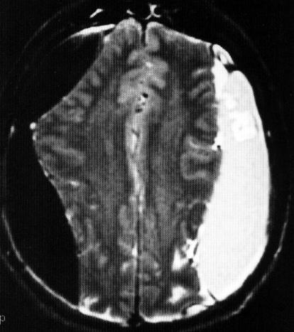 Angioressonância: diagnosticar lesões de seio venosos ou arteriais.