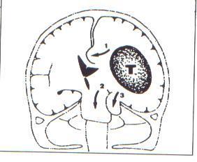 - HIC: efeitos mecânicos = Hérnias cerebrais e efeitos circulatórios = isquemia (compressão das estruturas vasculares e pela diminuição da pressão de perfusão cerebral.