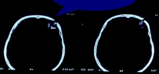 encefálico Hemorragia intraventricular