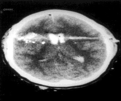 - Tratamento: Cirurgia está indicada quando exerce efeito de massa.