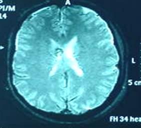 Diagnóstico: CT de crânio:(9,1%) Áreas Hemorrágicas menores que 1 cm, substância branca,