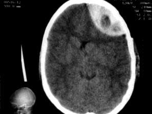 - QC: História trifásica clássica (tempo de 4 a 6 horas) (20% casos). - Cefaléia-- agitação psicomotora sonolência torpor coma - Deterioração Neurológica:.