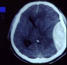 95% Fratura de Crânio ( temporal ou parietal ) CT de crânio: Forma lente, 2/3 hiperdenso, 1/3 misto, próximo tábua interna, demarcada pela duramater