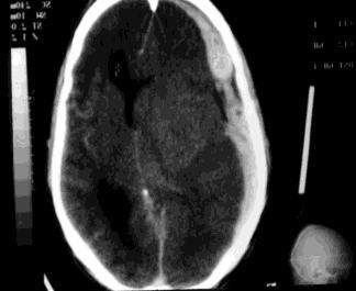 Cefaléia, crise convulsiva, Alteração estado mental, sonolência a coma Diagnóstico: CT de crânio: Difuso, 60%hiperdenso, 40% misto, convexidade, borda