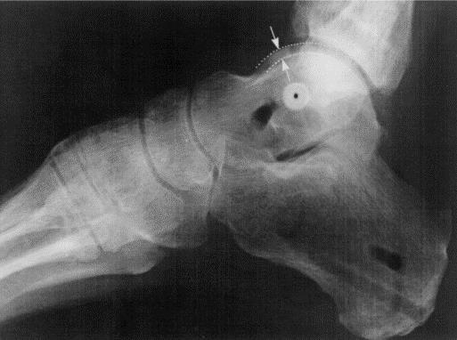 Figura 4.48 Dupla sombra visível na superfície superior do tálus numa radiografia exposta num plano perpendicular ao eixo determinado [56].