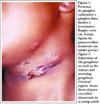 Micoses o Sistêmica: infecções no interior do corpo, podem afetar vários tecidos e órgãos.