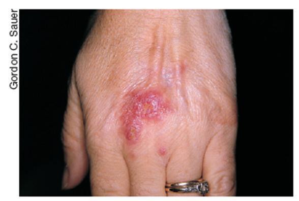 Micoses o Subcutâneas: infecções localizadas abaixo da pele, geralmente via trauma.