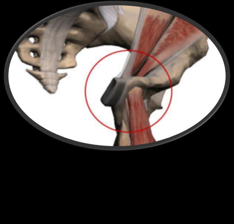 Pubalgia do Atleta Fisiopatologia: Causa: Forças de torque crônicas e de repetição na sínfise púbica Lesão da aponeurose comum dos tendões do reto abdominal e