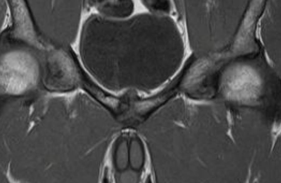 púbica do reto abdominal Tendinopatia do adutor longo