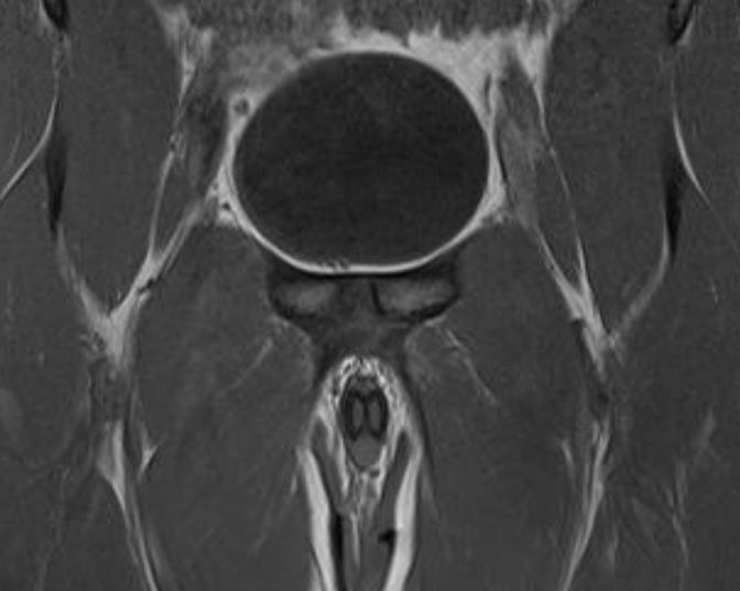 Sínfise Púbica Anatomia muscular Insersões musculotendíneas