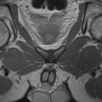 Sínfise Púbica Planos axial oblíquo e sagital Líquido-sensíveis (T2 FS ou