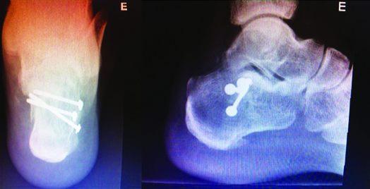 Tratamento artroscópico das fraturas intra-articulares do calcâneo: relato de caso e revisão da literatura Figura 7 - Radiografias pós-operatórias demonstrando a fixação e a redução da faceta