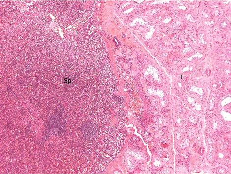 Seu histórico cirúrgico incluía orquidopexia do lado direito para testículo inguinal realizada aos 31 anos de idade.