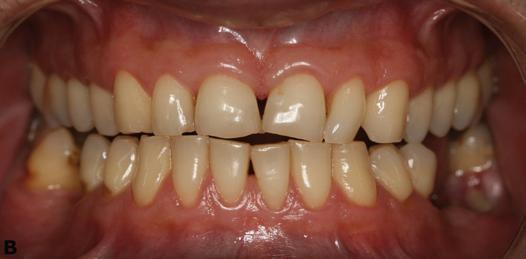Mobilidade dentária, desgaste dentário e lesões cervicais de origem não cariosa foram citadas pelo autor como sendo as consequências.