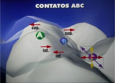 Neste caso uma força diagonal é sempre gerada, e sua decomposição em vetores leva a resultantes verticais (axiais) e resultantes horizontais indesejáveis quando este for o único contato oclusal