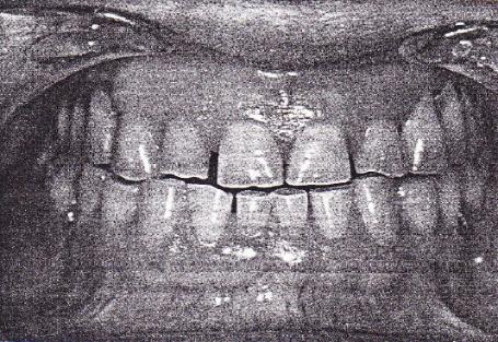 32 Figura 5 Alteração da DVO por desgaste dentário Fonte: Barbosa, C. et al. (2004) Figura 6 - Reabsorção de rebordo ósseo em radiografia panorâmica Fonte: Alves et al (2008).