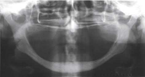 A dimensão vertical apresentou-se extremamente reduzida, mas não houve relato de dor muscular ou articular, todavia ruídos puderam ser percebidos durante abertura bucal.