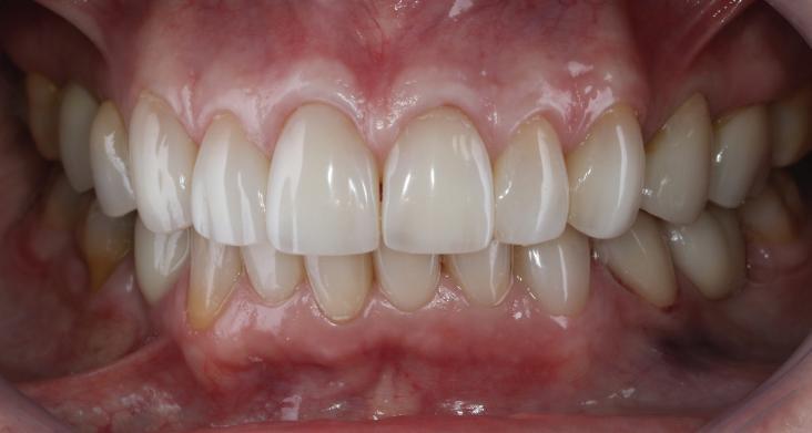 Para esse caso, os autores construíram um jig de referência e utilizaram o espaço interoclusal para aumento da DVO, a partir daí foi realizado reconstrução com resina nos dentes posteriores para