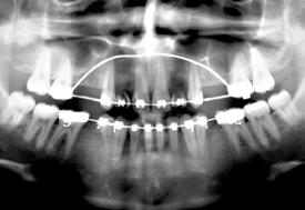 Na proservação logo no 1º ano observou-se radiograficamente perda óssea ao redor da plataforma do implante (salsserização) típico dos implantes
