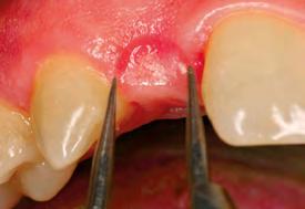 PLANO DE TRATAMENTO Instalação de implantes osseointegrados nas regiões dos elementos 12 e 22. 01 02 01-03 Aspecto clínico inicial.