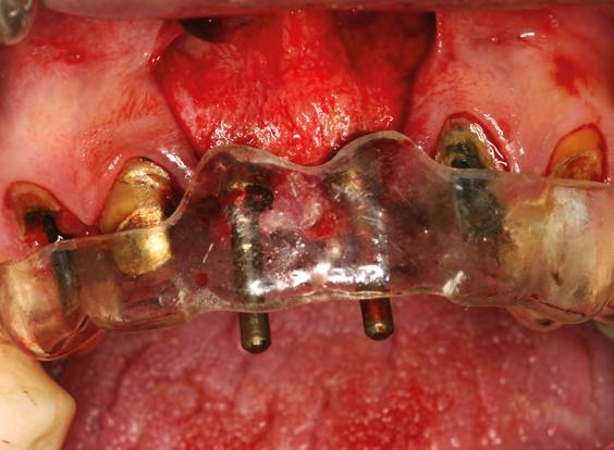 02,03 Paralelômetro em posição evidenciando bom paralelismo entre os implantes e bom posicionamento em relação ao guia cirúrgico.