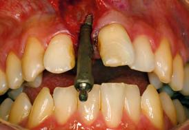 sido realizada. Além disso, o paciente não se sentia seguro com aquela prótese e desejava ter os dentes separados.