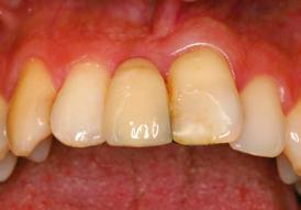 osseointegrável na região do elemento 11, seguido de coroa temporária e tratamento de dentística dos elementos 12, 21 e