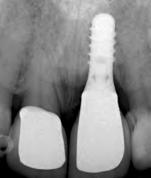 (1992), observou-se que quando a distância do ponto de contato dos dentes até a crista óssea varia entre 3 a 5mm, a papila está presente em todos os casos.