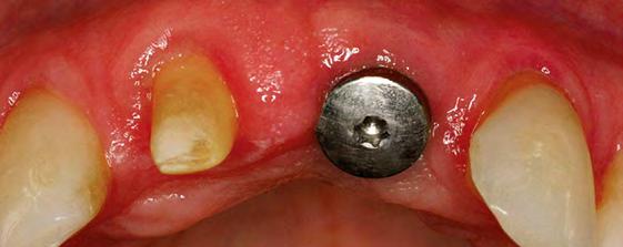 Implante Straumann RN, diâmetro da plataforma do implante 4,8 mm que se aproxima do perfil de emergência do dente natural.