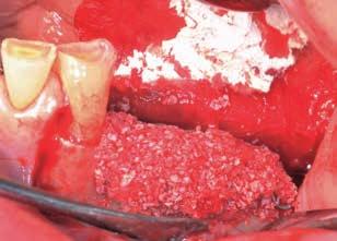 Fig. 6 Enxerto com osso autógeno coletado da região de ângulo da mandíbula e misturado,