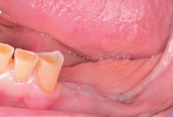 extensão intra-sulcular na direção dos primeiros dois dentes da extremidade mesial.