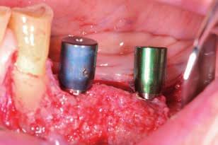 São administrados antibióticos durante 8 10 dias após cirurgia reconstrutiva. Fig.