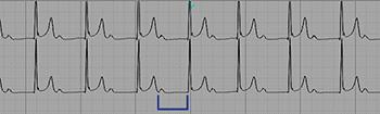 Página: 4 de 8 3.3 Bloqueio atrioventricular (BAV) de primeiro grau BAV de primeiro grau (PR: 520 ms) Caracterizado por ritmo sinusal com intervalo PR> 200ms em adultos. Normalmente benigno.