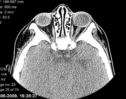 Pedro Brito, Amândio Rocha-Sousa, Augusto Magalhães, Jorge Breda, Fernando Falcão Reis Fig. 3 TC órbita 6 meses após transplante.