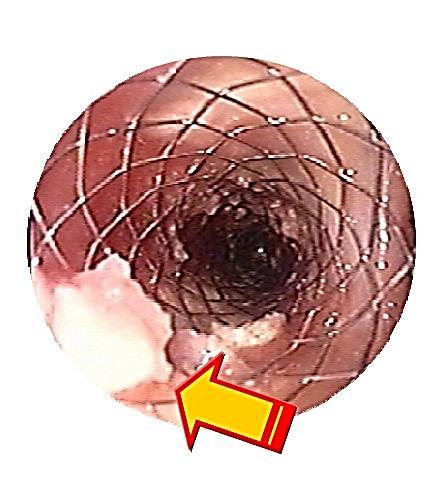 struts. High danger embolization with vulnerable plaques.