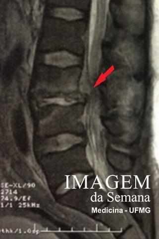 Imagem 3: Ressonância Magnética, corte sagital, em T2 - redução do espaço discal L3- L4, associada a abaulamento discal posterior, que condiciona compressão de estruturas adjacentes.