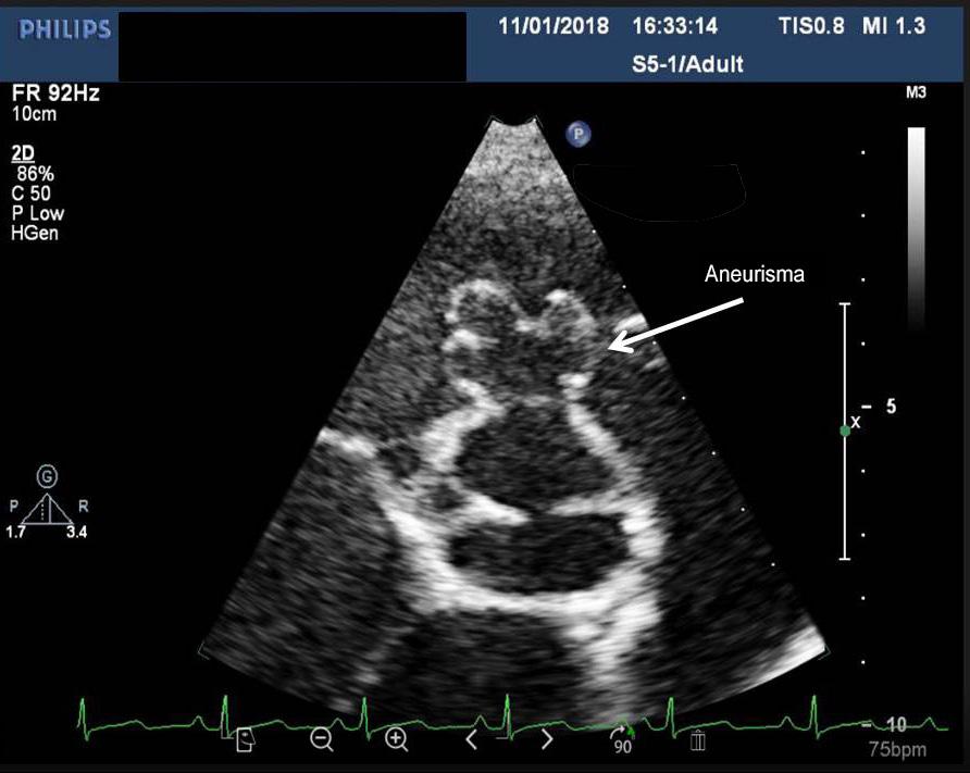 Figura 1 Aneurisma do seio coronariano direito. Figura 2 Fístula do seio coronariano-ventrículo direito, pelo ecocardiograma transtorácico.