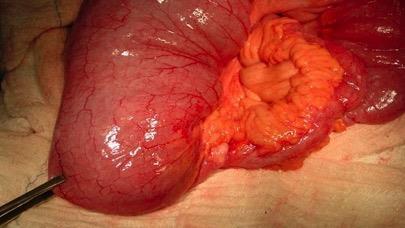 CROHN cirurgias