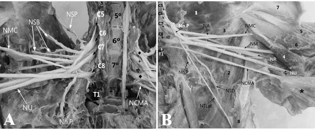 Figura 2 (A-B). Vista medial do plexo braquial de tamanduá-mirim (Tamandua tetradactyla): Origem, composição dos troncos e nervos resultantes.