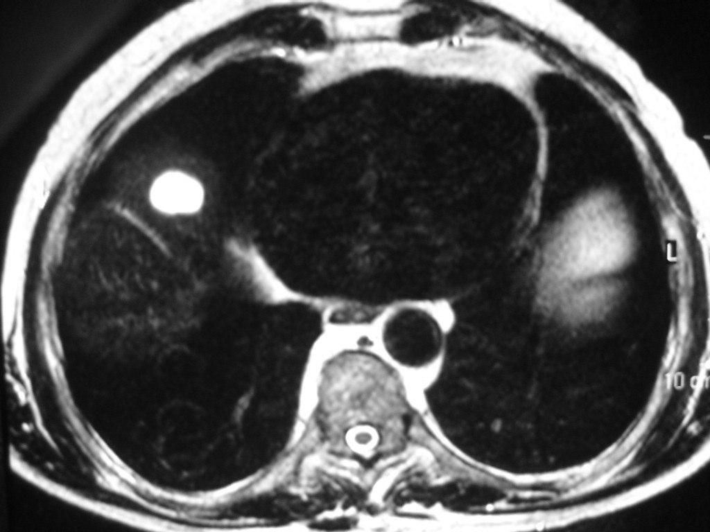 1 Padrão-ouro A fim de determinar se o nódulo observado era um cisto simples ou um hemangioma, um radiologista com ampla experiência em RM do abdome (GD)