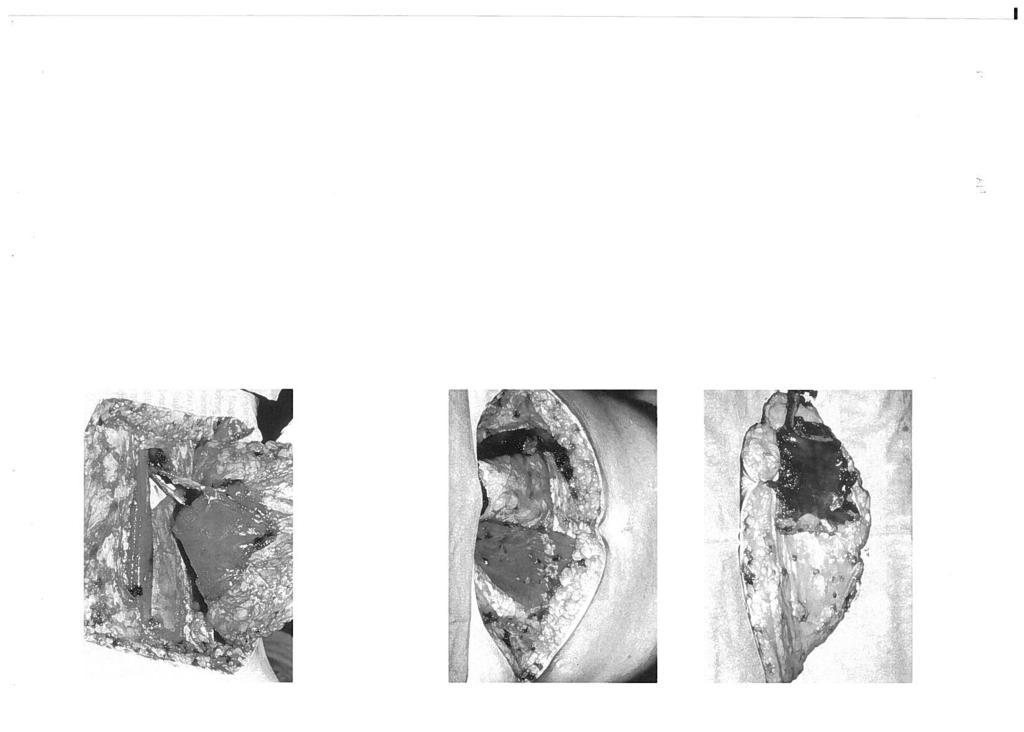 1. J. FREIRE DOS 5 ~\TOS INTRODUÇÃO A reconstrução mamária tem por objectivos, diminuir o traumatismo psicológico das doentes mastectomizadas, melhorando o contorno pessoal e preservando ou resti