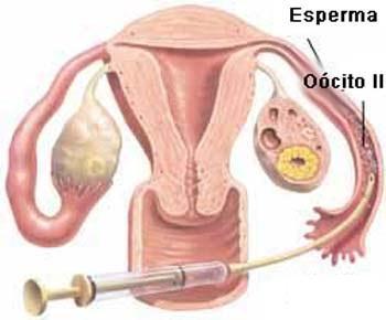 Fertilização in vivo assistida Faz-se superovulação hormonal Ocorre a coleta dos oócitos e espermatozoides Vários oócitos e