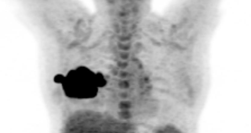 Prova Escrita Dissertativa CASO 1 OV, masculino, 64 anos, em estadiamento de carcinoma epidermoide moderadamente diferenciado de